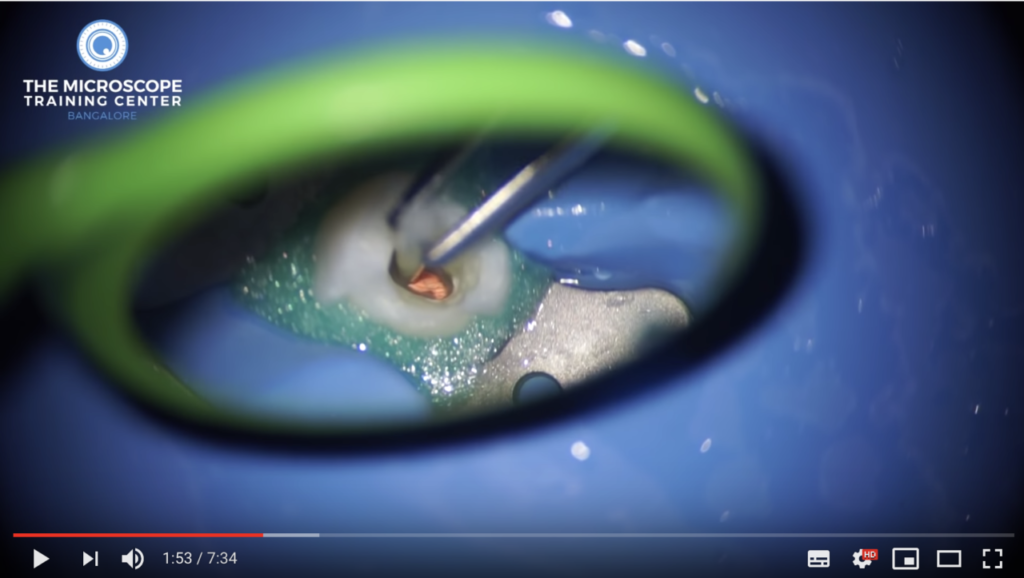 DM_il dentista moderno_Compositi bulk-fill_restauro post endodontica perno in fibra