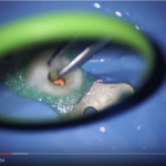 Compositi bulk-fill: sono impiegabili nelle ricostruzioni con perno in fibra DM_il dentista moderno_Compositi bulk-fill_restauro post endodontica perno in fibra