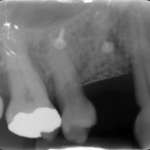 Rigenerazione verticale con griglie in titanio e rigenerazione parodontale: caso clinico a 7 anni