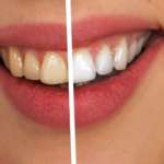 Sbiancamento domiciliare addizionato a infiltrazione di resina nel trattamento delle fluorosi