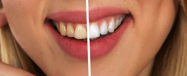 Sbiancamento domiciliare addizionato a infiltrazione di resina nel trattamento delle fluorosi