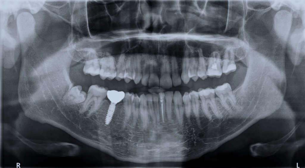 DM_IL-DENTISTA-MODERNO_radiografia_impianto-dentale_postestrattivi