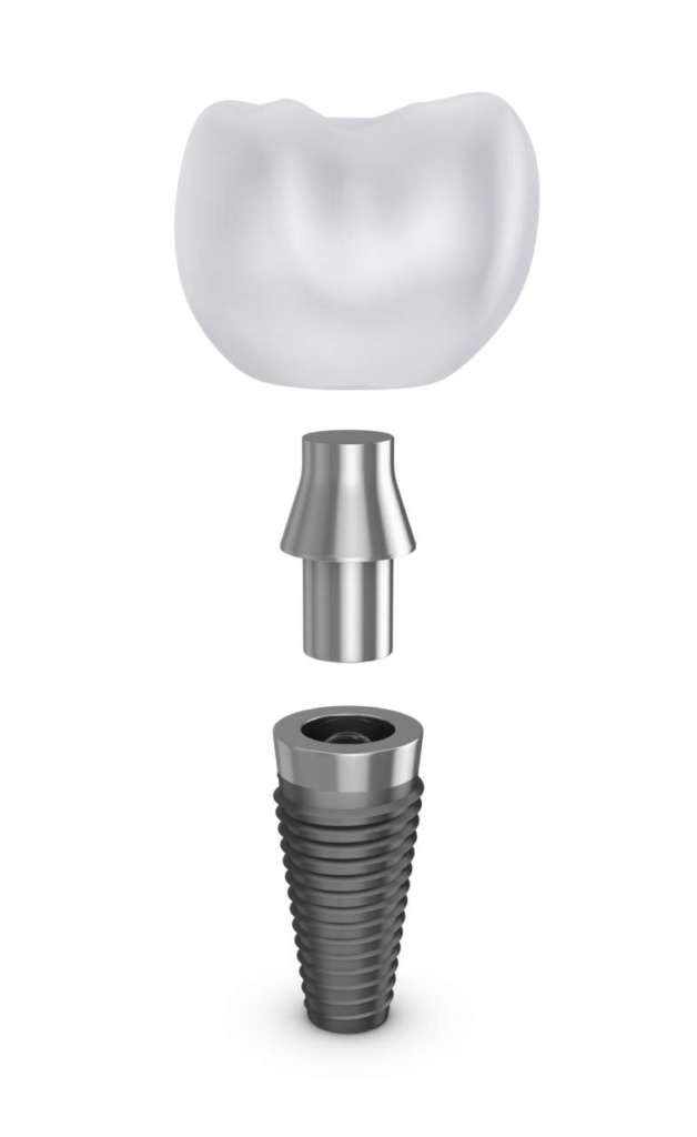 DM_il-dentista-moderno_impianto_implantologia_isq_monitoraggio implantare