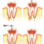 Ecografia in endodonzia per la diagnostica delle fistole DM_il-dentoista-moderno_endodonzia_terapia-canalare_ecpgrafia in endodonzia