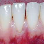 Correzione di inestetismi gengivali con due diverse tecniche chirurgiche