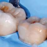 Estetica e funzione in protesi adesiva: restauri coronali parziali in composito