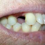 Dispositivo protesico mobile in pazienti non candidati all’implantologia