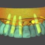 La riabilitazione del mascellare completamente edentulo tramite soluzioni a supporto implantare