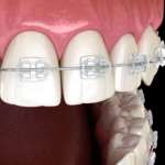 Posizionare i bracket ortodontici con fonti di luce ad alta intensità