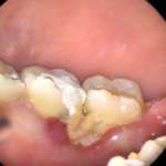 Trattamento endodontico di un molare inferiore con necrosi mucogengivale da medicamento e perforazione del pavimento della camera pulpare