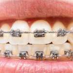 Apparecchi funzionali nel trattamento delle malocclusioni di II classe: impatto sull’articolazione temporo-mandibolare