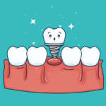 Timing della riabilitazione implantare di un trauma dentale