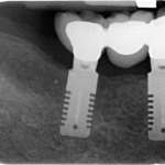 Cresta ossea sottile trattamento con impianto cuneiforme e preparazione piezoelettrica minivasiva