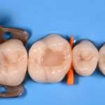 La ricostruzione anatomica della cresta marginale nei restauri di classe II