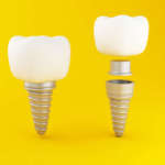 Abutment in zirconia: riduzione della perdita di osso crestale DM_il-dentista-moderno_Possibile-vantaggio-dell’uso-di-abutment-in-zirconia-riduzione-della-perdita-di-osso-crestale.