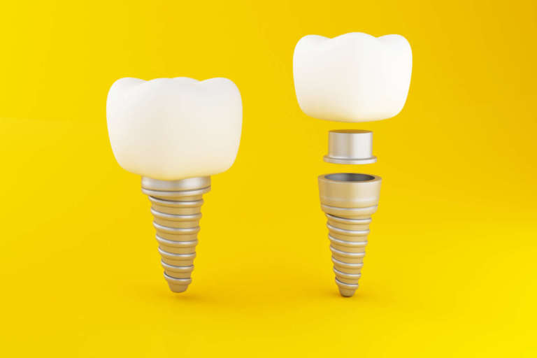 Abutment in zirconia: riduzione della perdita di osso crestale