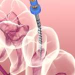 Trattamento endodontico guidato in caso di apertura della bocca limitata Trattamento endodontico_Impatto della sezione e della conicità dello strumento Ni-Ti nella sagomatura di canali a S