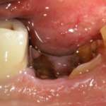 Strategia interdisciplinare per un dente gravemente compromesso