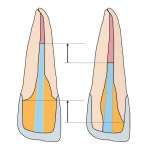 Adesione a livello coronale di perni in composito rinforzato con fibra di vetro