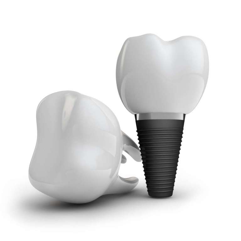 Evidenze sui protocolli e parametri di successo in implantologia postestrattiva