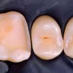 Cementazione dentale, i principi cardine da tenere a mente