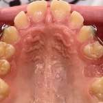 Efficacia del trattamento delle seconde classi con dispositivo Carriere Motion