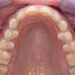 Riabilitazione estetico funzionale in un caso di usura meccanica