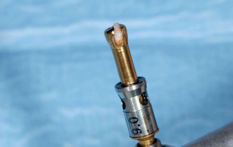 Il rialzo del seno mascellare per via crestale con strumenti rotanti: risultati a 4 anni