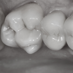 I restauri indiretti nel dente trattato endodonticamente Restauri_indiretti_Luca_Tacchini