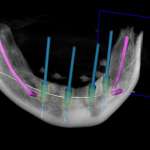 Riabilitazione orale full-arch su quattro impianti mediante pianificazione computer guidata