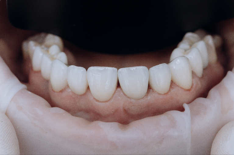 Riabilitazione tramite workflow digitale ”fully guided” di un’arcata e uso di una nuova tipologia di abutment a memoria di forma