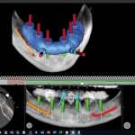 Approccio digitale dell’implantoprotesi nel paziente parzialmente edentulo