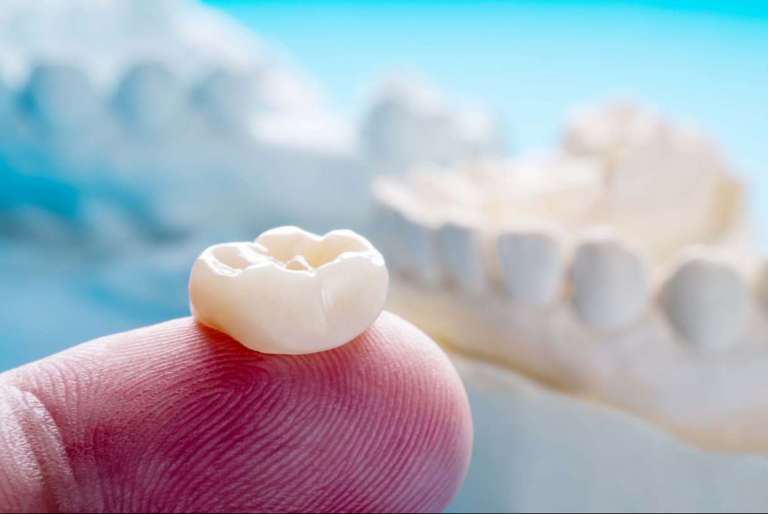 Procedure adesive e di cementazione sulla zirconia