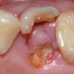 Autotrapianto di terzo molare superiore: case report con 6 mesi di follow up