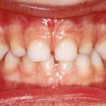 Traumatologia dentale in età evolutiva: i traumi in dentizione decidua