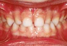 Traumatologia dentale in età evolutiva: i traumi in dentizione decidua