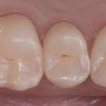 Cementazione: non è solo questione di chimica