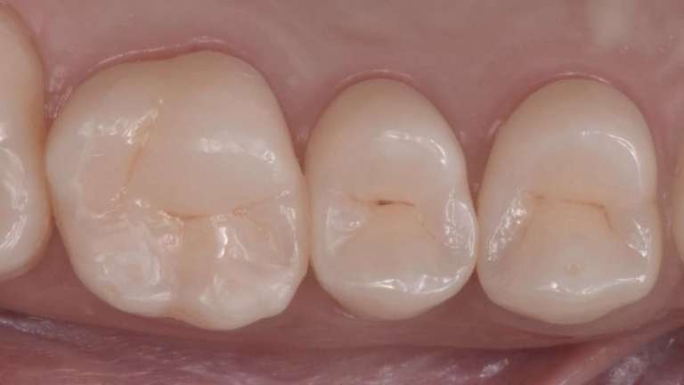 Cementazione, non è soltanto questione di chimica