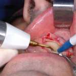 Chirurgia degli elementi dentari inclusi con applicazione delle tecniche piezoelettriche