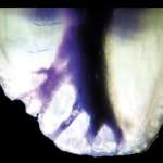 Otturazione tridimensionale dei canali radicolari con guttaperca riscaldata: una nuova tecnica