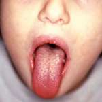 La malattia di Kawasaki: manifestazioni orali in primo piano