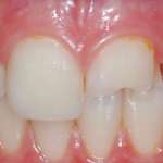 Restauro diretto o indiretto? Questo è il problema