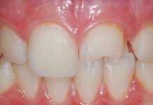 Restauro diretto o indiretto? Questo è il problema