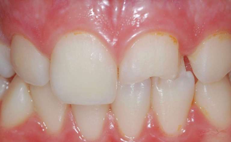 Restauro diretto o indiretto? Questo è il problema