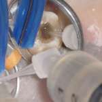 La detersione del sistema dei canali radicolari