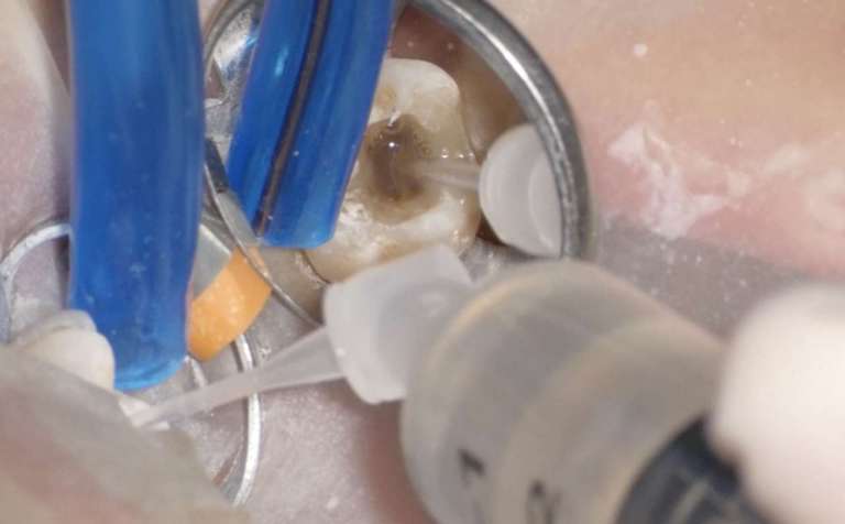 La detersione del sistema dei canali radicolari