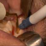 Grazie alla piezochirurgia gli elementi dentari inclusi non fanno più paura