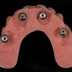 Utilizzo di una protesi provvisoria premade per riabilitare la mascella edentula secondo il concetto di trattamento All-on-4®