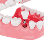 Lo spessore della mucosa cheratinizzata come fattore predittivo chirurgico nella perimplantite DM_il-dentista-moderno_Lo-spessore-della-mucosa-cheratinizzata-come-fattore-predittivo-chirurgico-nella-perimplantite.jpg