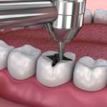 Tasso di sopravvivenza dei restauri conservativi e motivi di fallimento